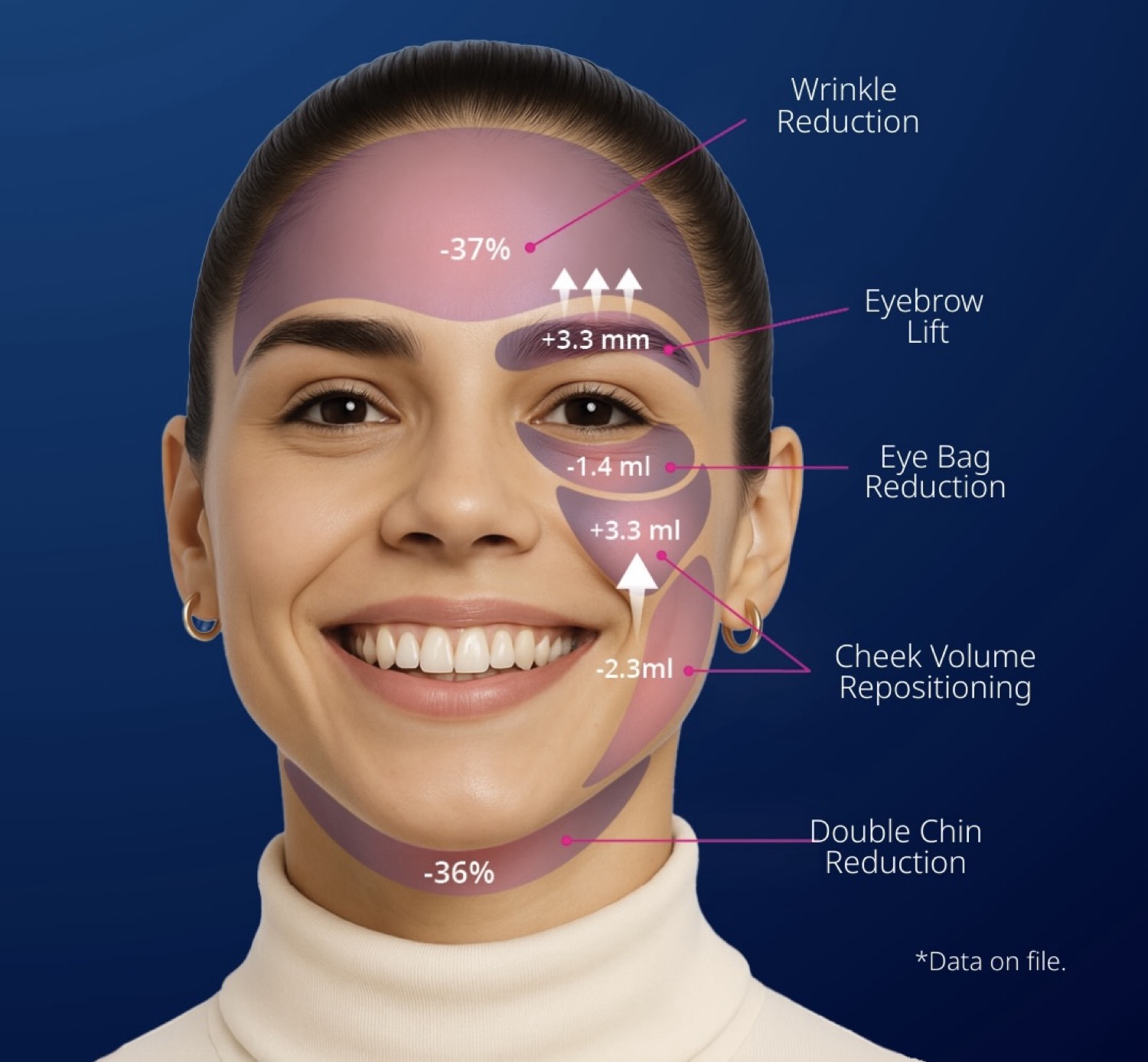 EMFACE clinical result areas: forehead, eyes, cheeks and submentum